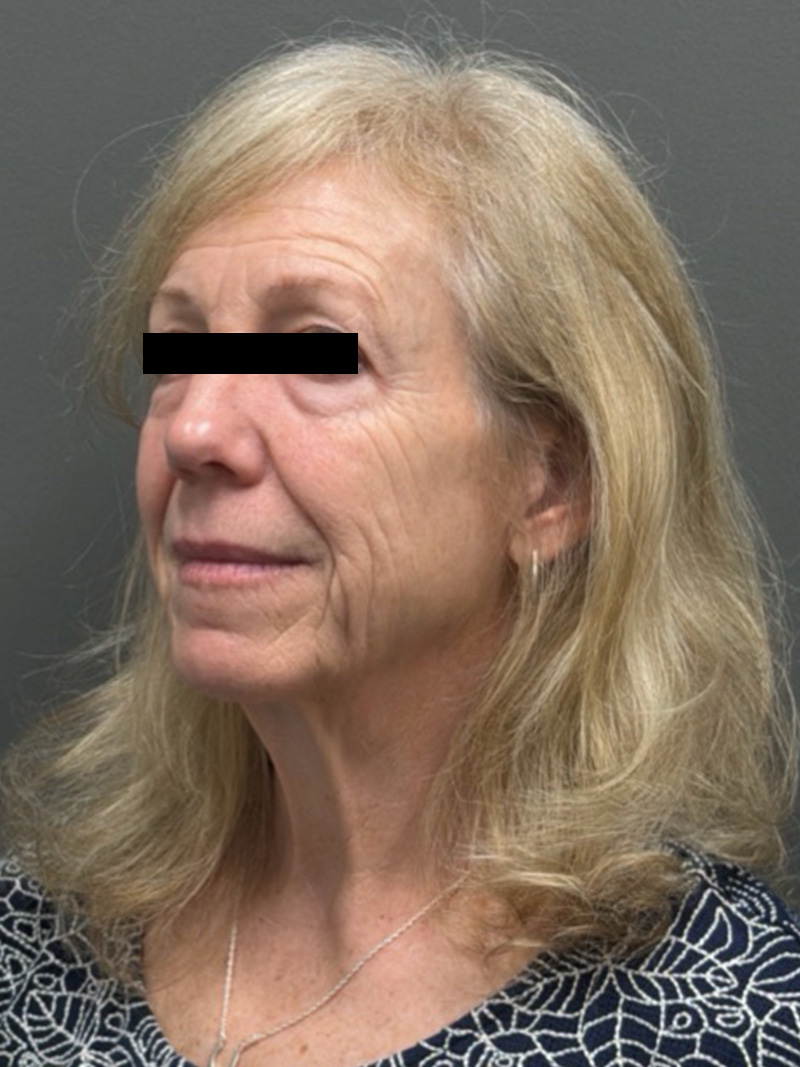 FACELIFT Before & After Gallery - Patient 141837 - Image 7