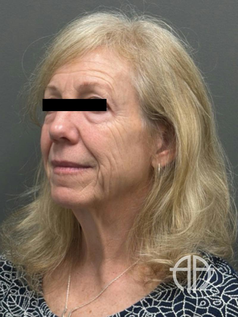 FACELIFT Before & After Gallery - Patient 141837 - Image 7