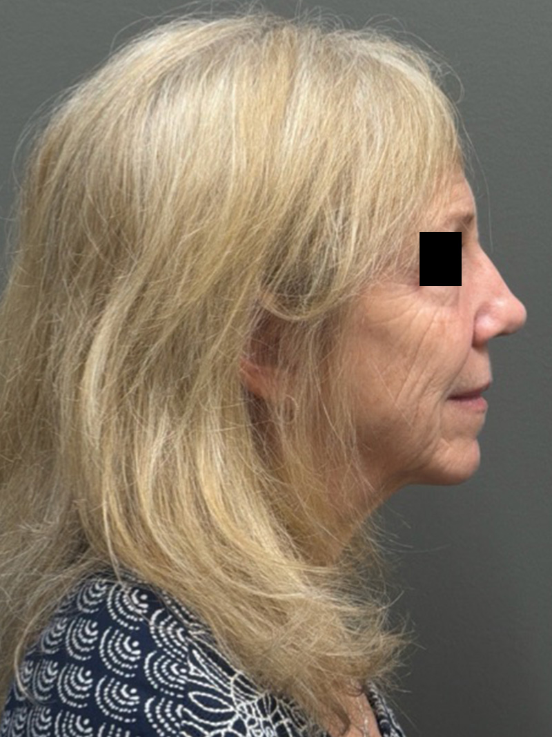 FACELIFT Before & After Gallery - Patient 141837 - Image 5