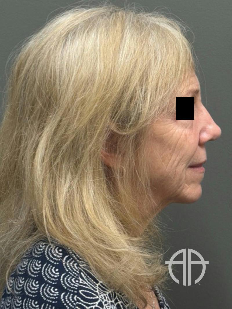 FACELIFT Before & After Gallery - Patient 141837 - Image 5