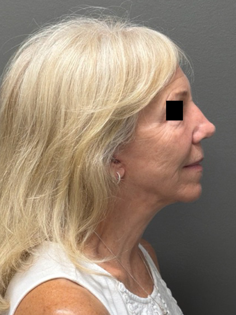 FACELIFT Before & After Gallery - Patient 141837 - Image 6