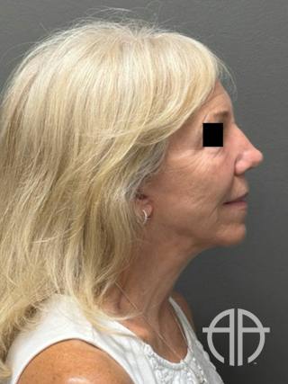FACELIFT Before & After Gallery - Patient 141837 - Image 6