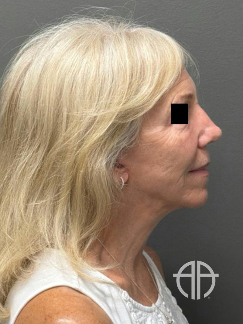 FACELIFT Before & After Gallery - Patient 141837 - Image 6
