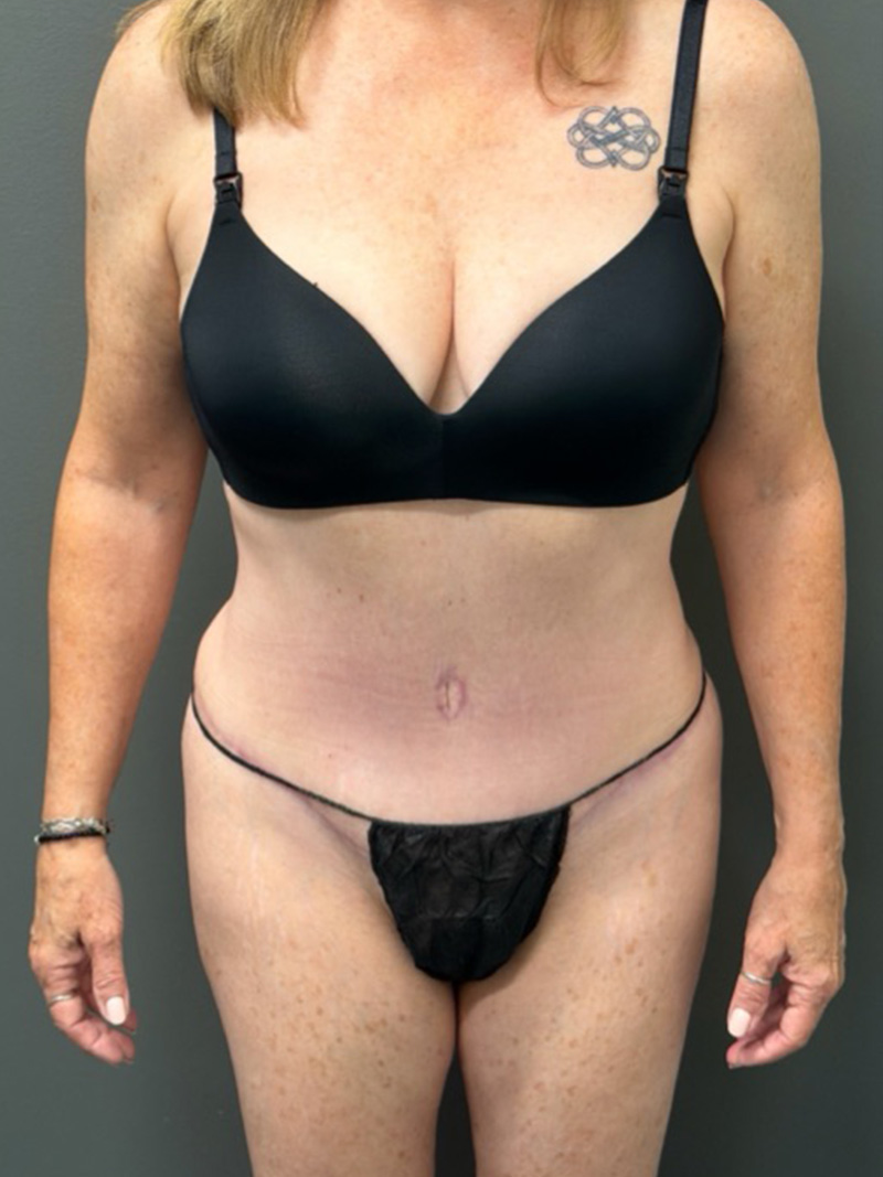 TUMMY TUCK Before & After Gallery - Patient 146221 - Image 2
