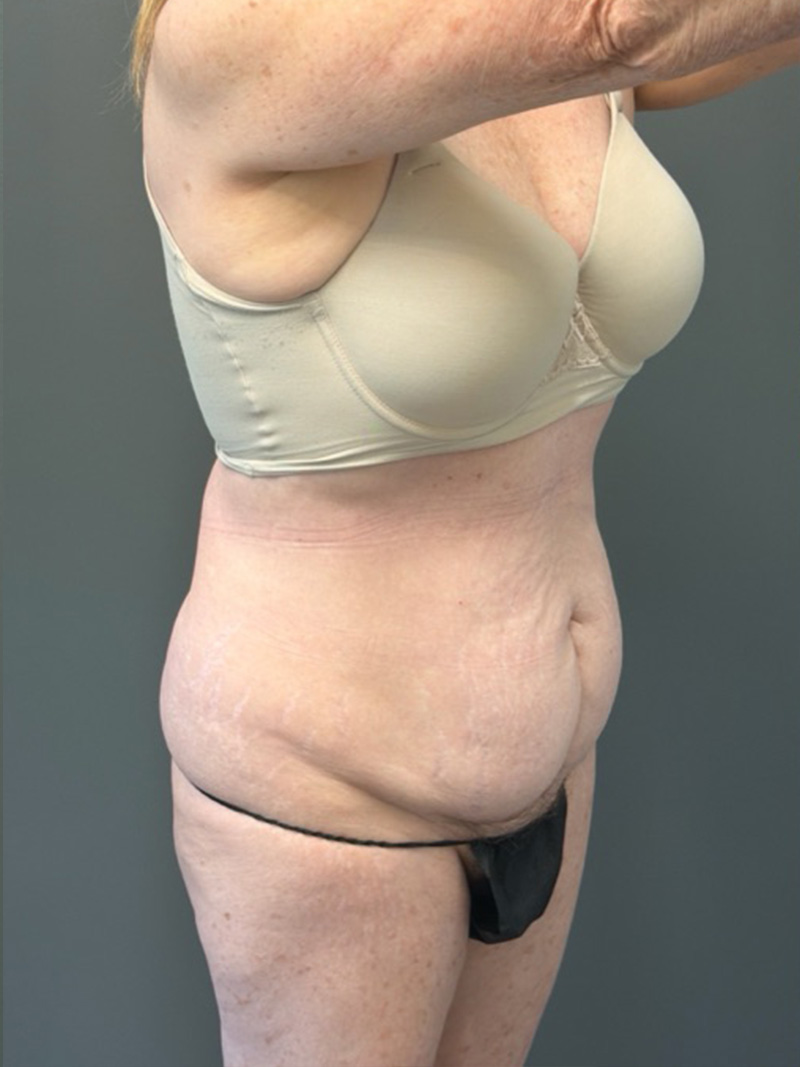 TUMMY TUCK Before & After Gallery - Patient 146221 - Image 3
