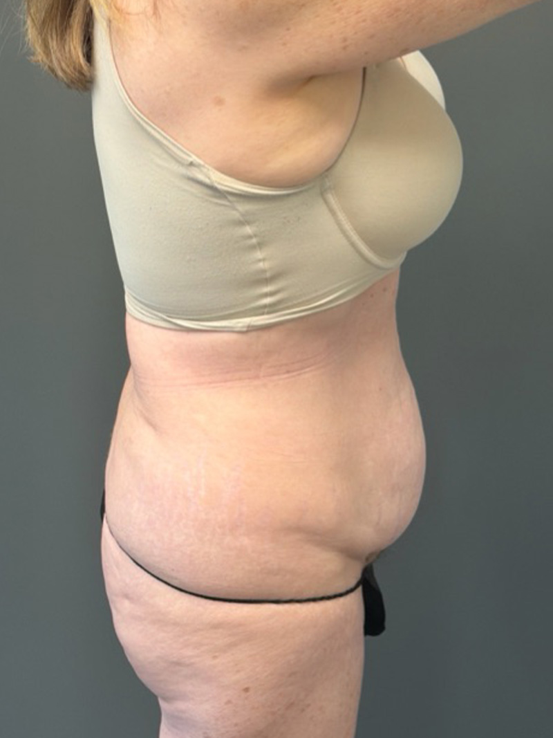 TUMMY TUCK Before & After Gallery - Patient 146221 - Image 5