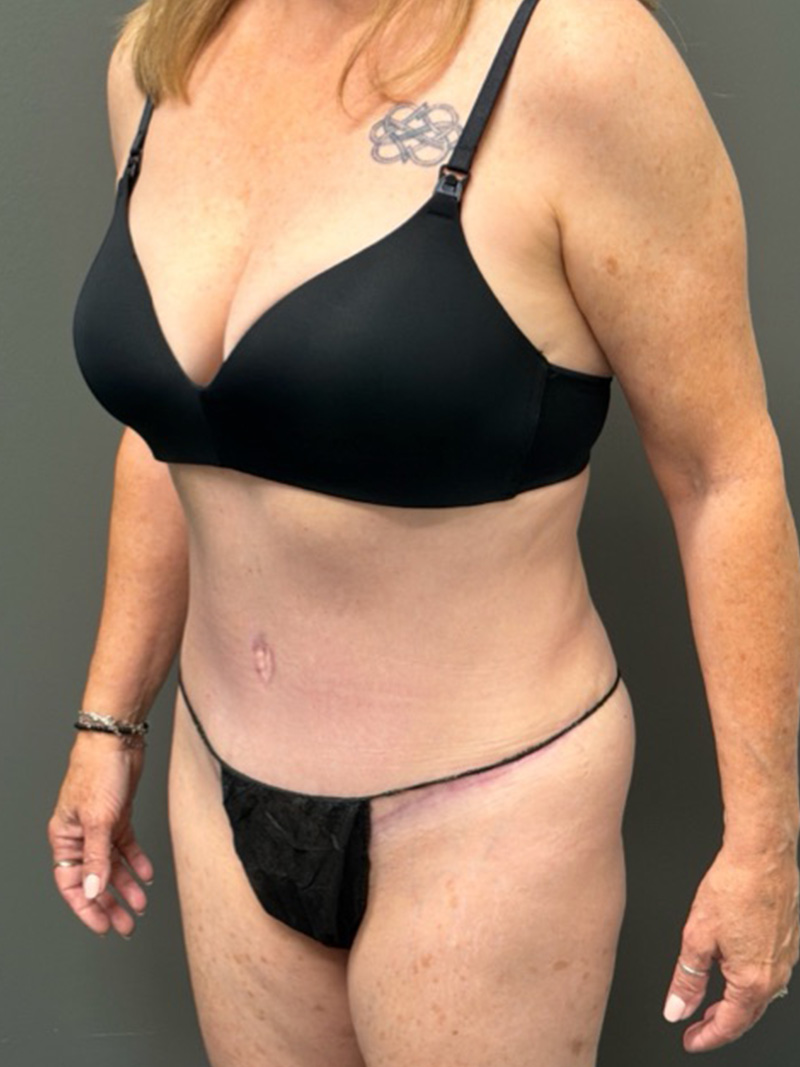 TUMMY TUCK Before & After Gallery - Patient 146221 - Image 8