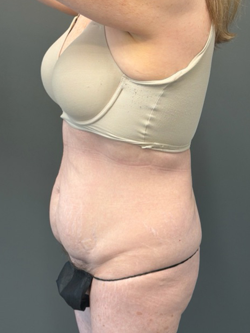 TUMMY TUCK Before & After Gallery - Patient 146221 - Image 9