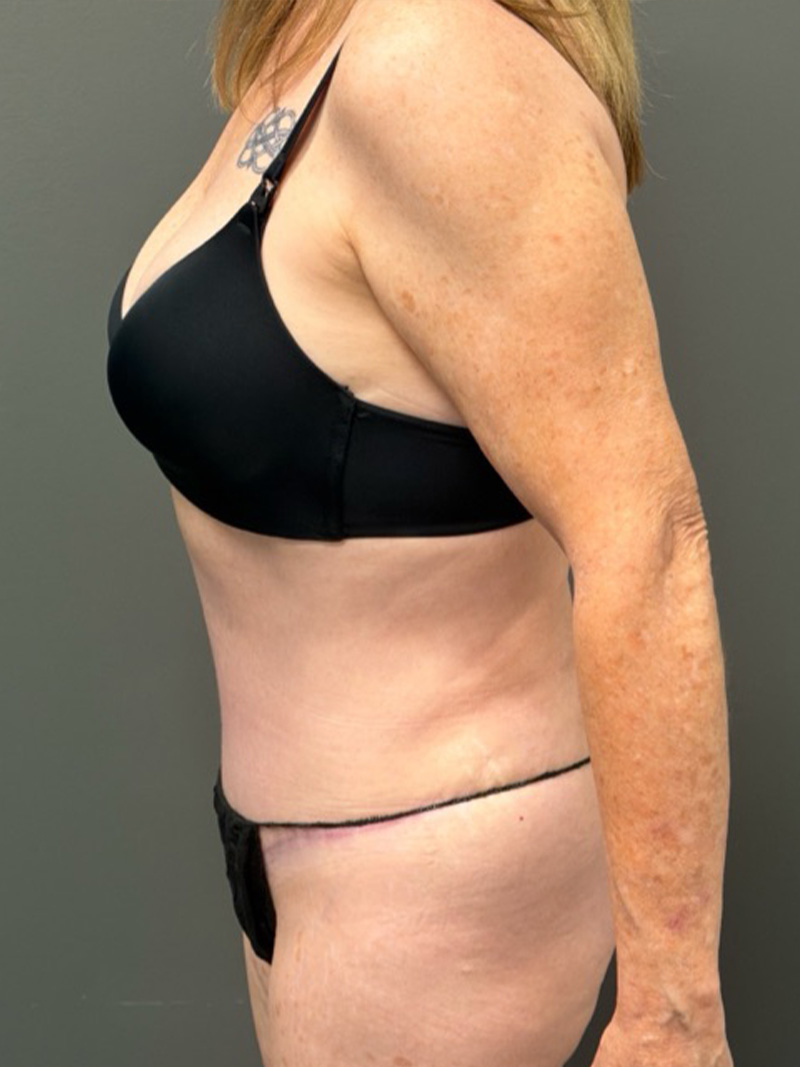 TUMMY TUCK Before & After Gallery - Patient 146221 - Image 10