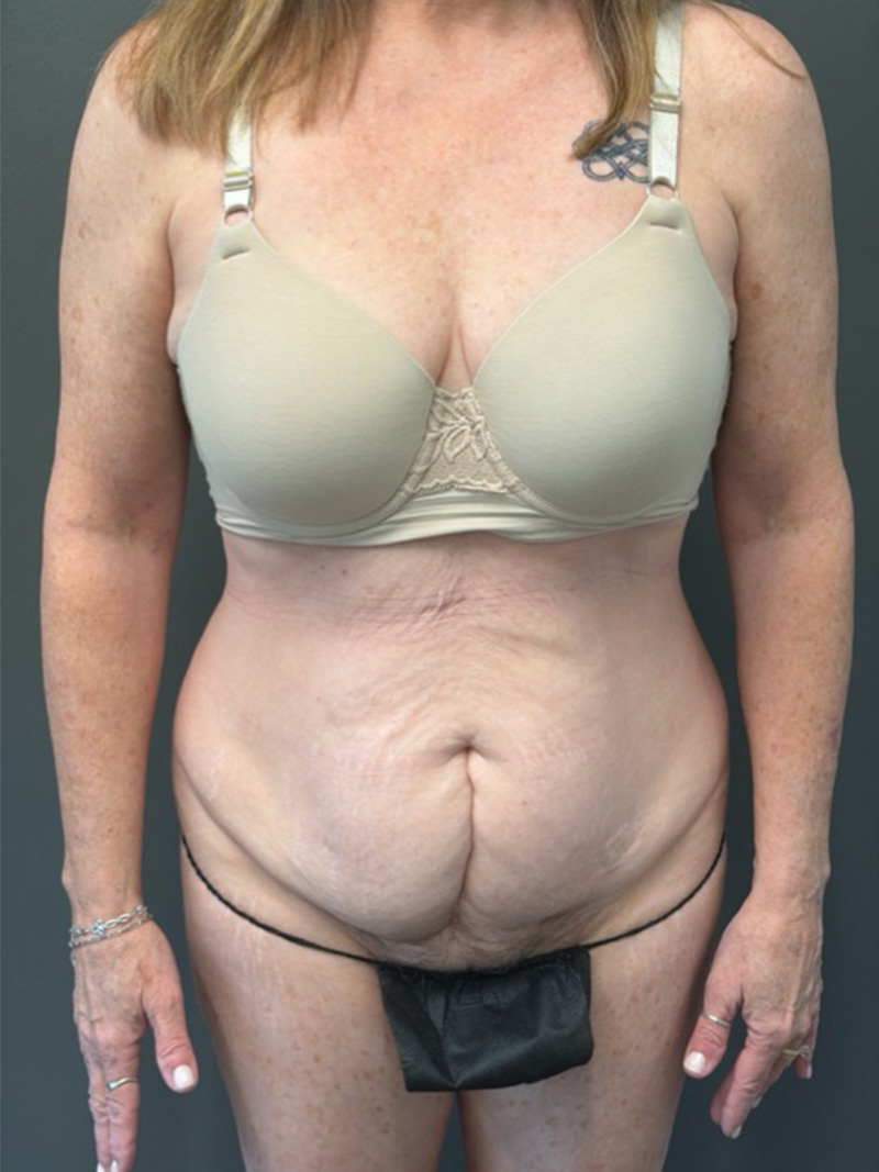 TUMMY TUCK Before & After Gallery - Patient 146221 - Image 1