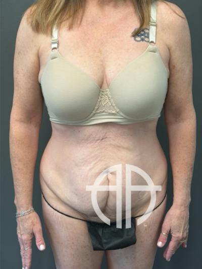 TUMMY TUCK Before & After Gallery - Patient 146221 - Image 1