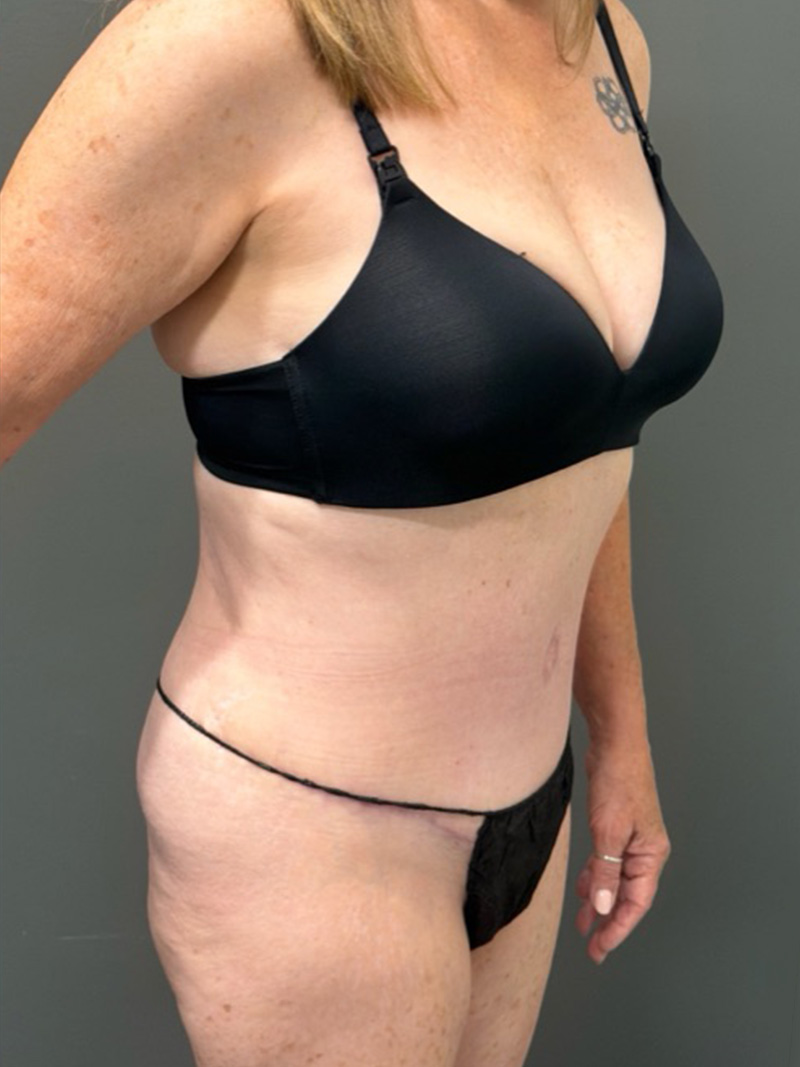 TUMMY TUCK Before & After Gallery - Patient 146221 - Image 4