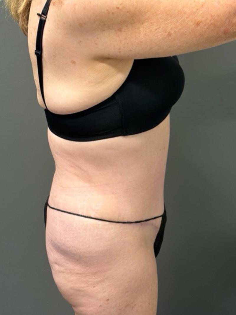 TUMMY TUCK Before & After Gallery - Patient 146221 - Image 6