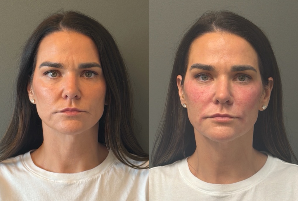 FACIAL BALANCING FILLER Before & After Gallery - Patient 166171 - Image 1