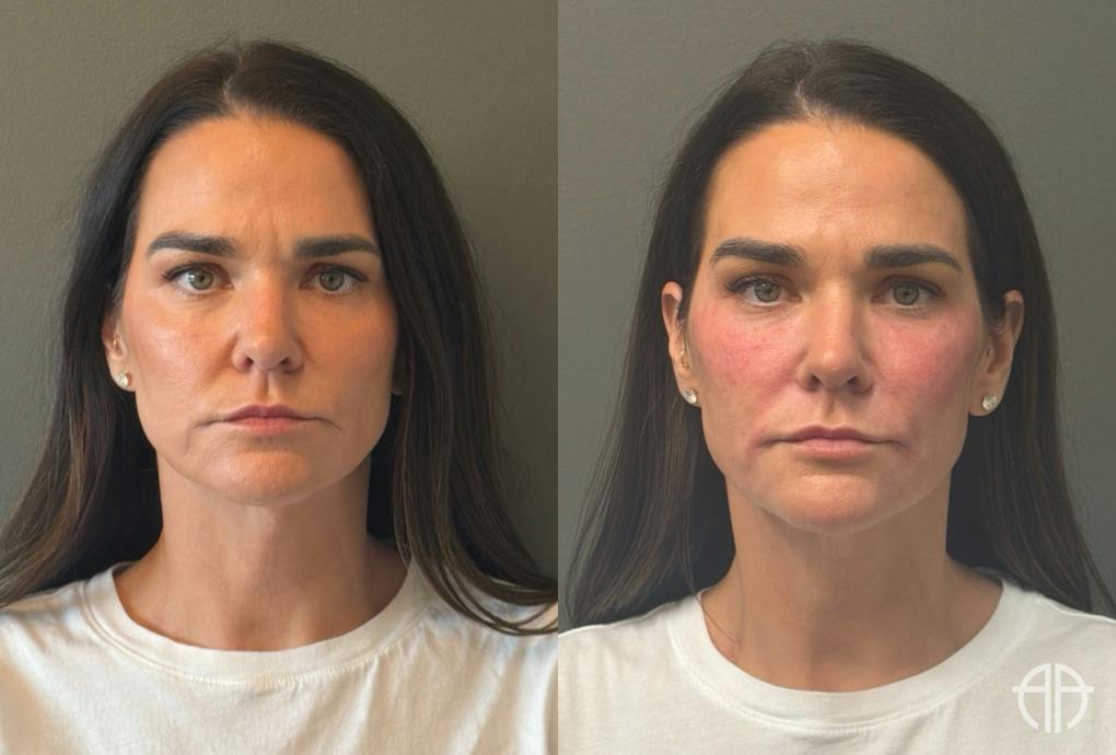 FACIAL BALANCING FILLER Before & After Gallery - Patient 166171 - Image 1