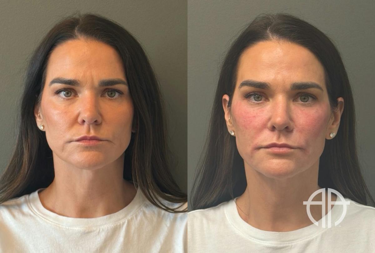 FACIAL BALANCING FILLER Before & After Gallery - Patient 166171 - Image 1