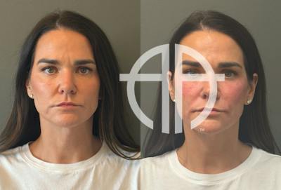 FACIAL BALANCING FILLER Before & After Gallery - Patient 166171 - Image 1