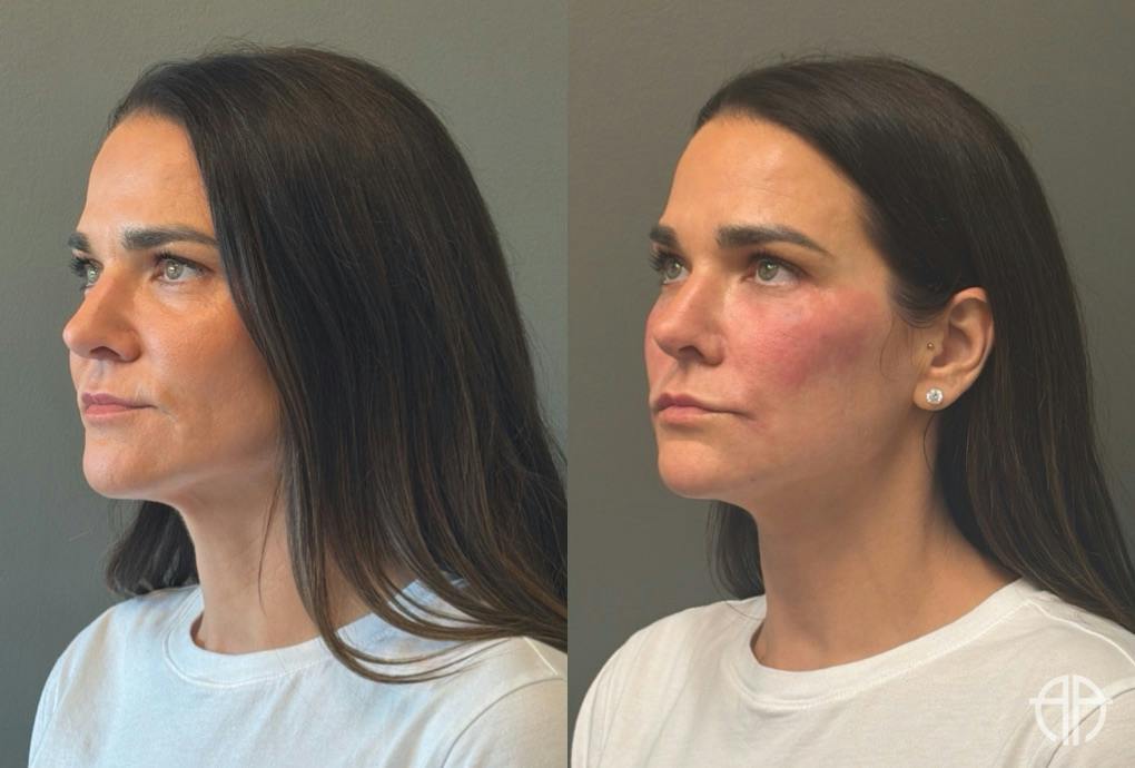 FACIAL BALANCING FILLER Before & After Gallery - Patient 166171 - Image 4