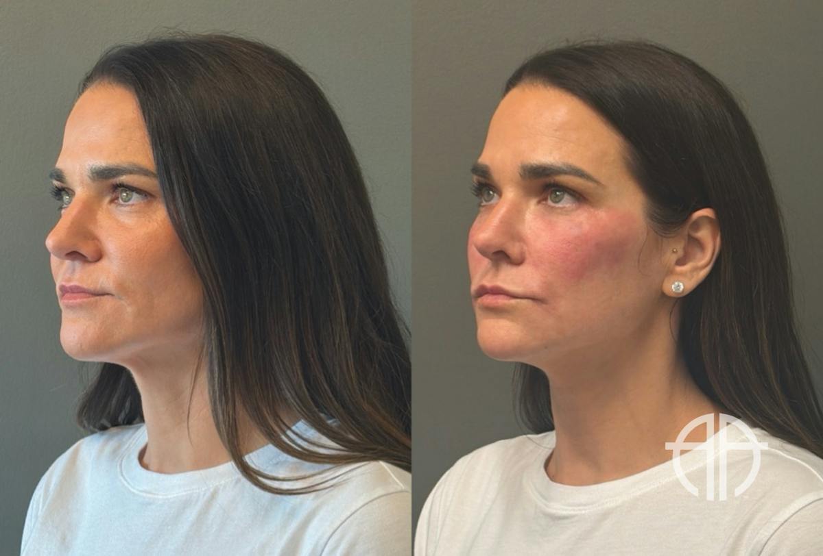 FACIAL BALANCING FILLER Before & After Gallery - Patient 166171 - Image 4