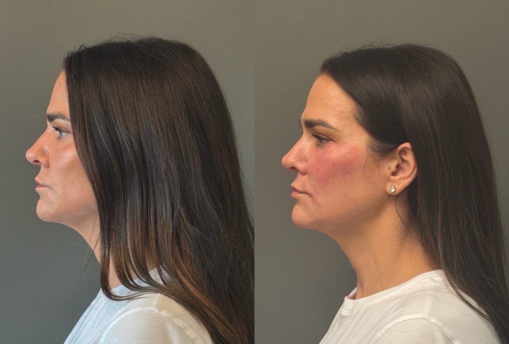 FACIAL BALANCING FILLER Before & After Gallery - Patient 166171 - Image 5