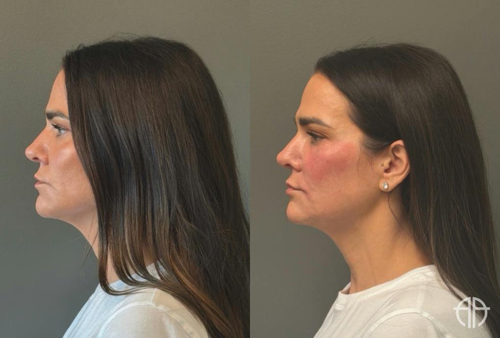 FACIAL BALANCING FILLER Before & After Gallery - Patient 166171 - Image 5