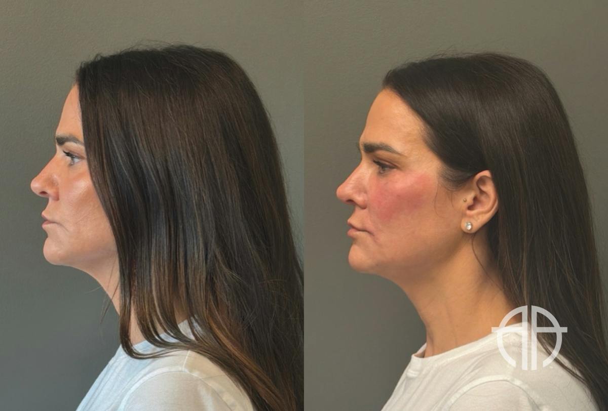 FACIAL BALANCING FILLER Before & After Gallery - Patient 166171 - Image 5