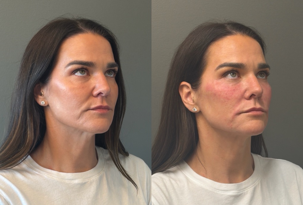 FACIAL BALANCING FILLER Before & After Gallery - Patient 166171 - Image 2
