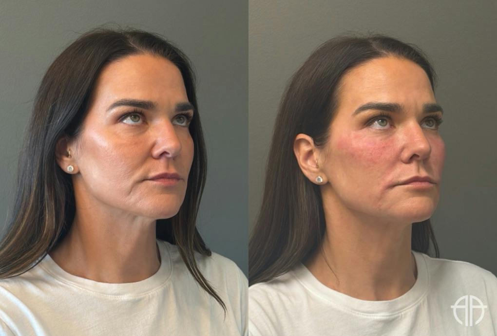 FACIAL BALANCING FILLER Before & After Gallery - Patient 166171 - Image 2