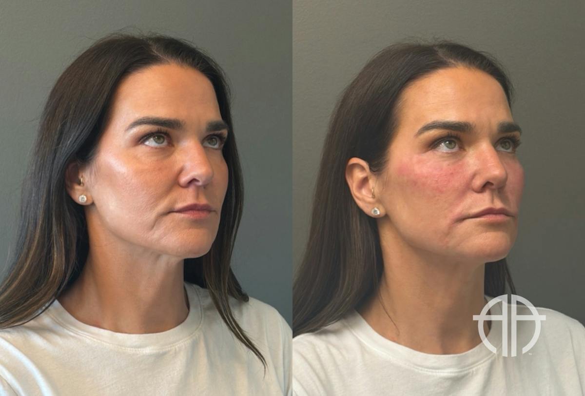 FACIAL BALANCING FILLER Before & After Gallery - Patient 166171 - Image 2