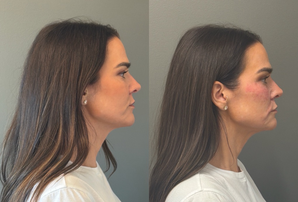 FACIAL BALANCING FILLER Before & After Gallery - Patient 166171 - Image 3