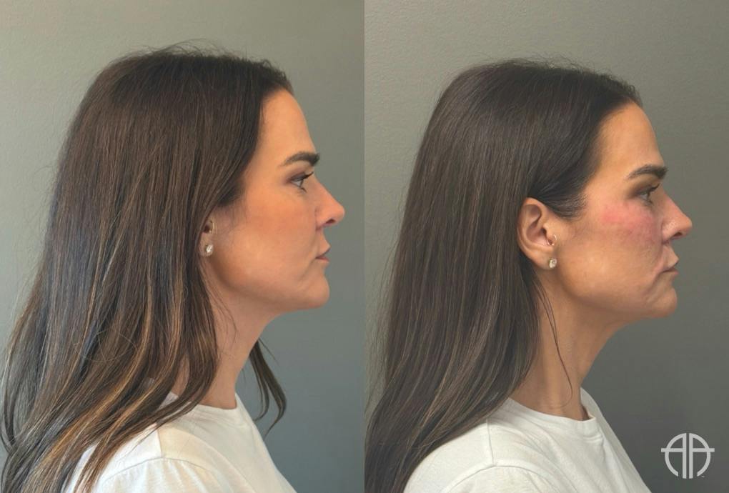 FACIAL BALANCING FILLER Before & After Gallery - Patient 166171 - Image 3