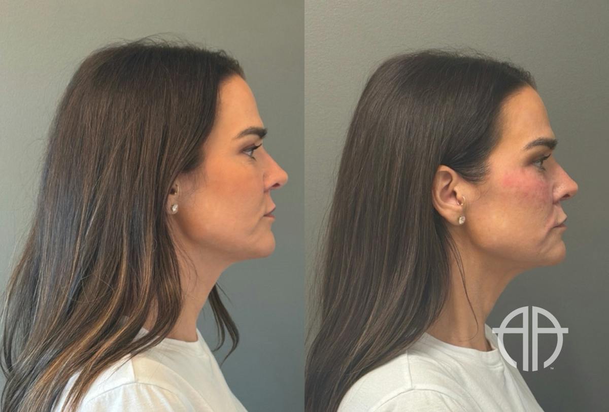 FACIAL BALANCING FILLER Before & After Gallery - Patient 166171 - Image 3
