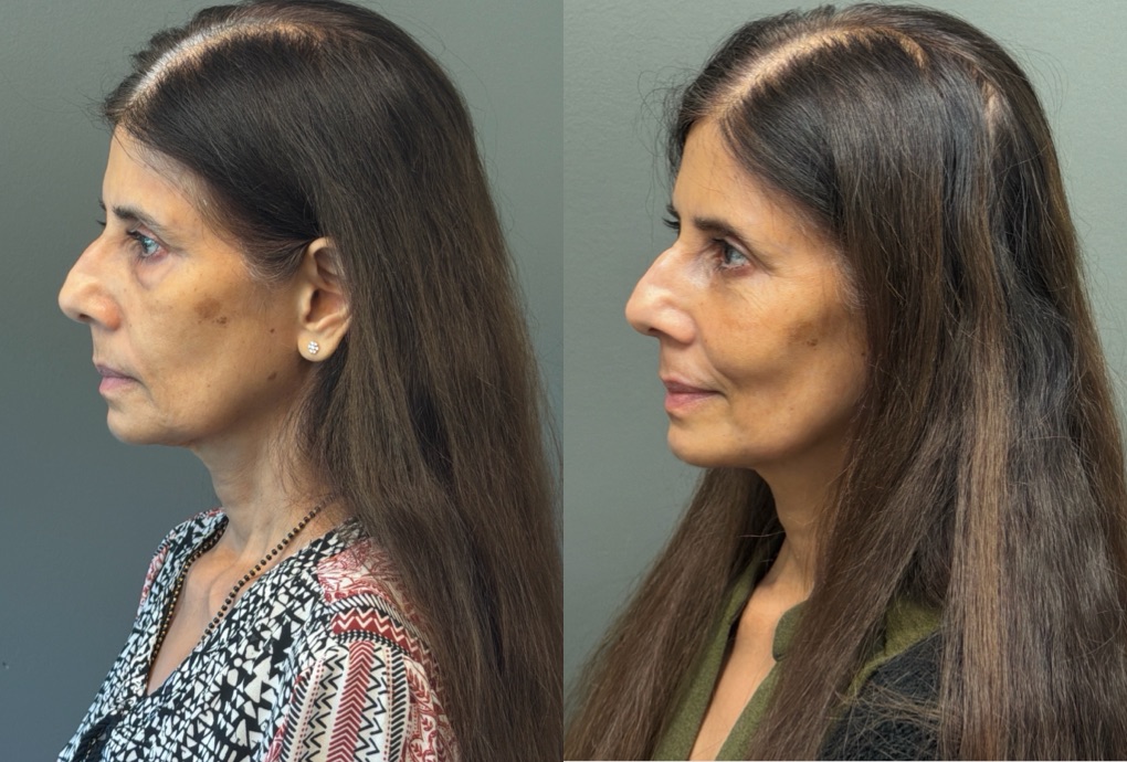 FAT GRAFTING Before & After Gallery - Patient 614030 - Image 4