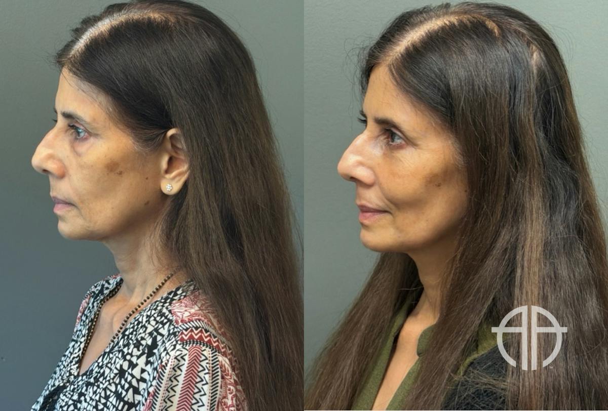 FAT GRAFTING Before & After Gallery - Patient 614030 - Image 4