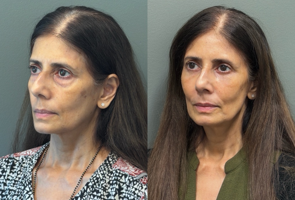 FAT GRAFTING Before & After Gallery - Patient 614030 - Image 2