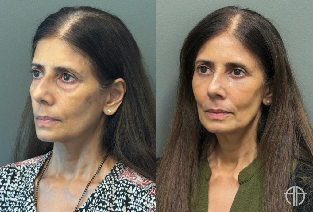 FAT GRAFTING Before & After Gallery - Patient 614030 - Image 2