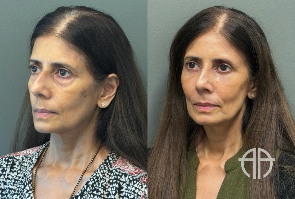 FAT GRAFTING Before & After Gallery - Patient 614030 - Image 2