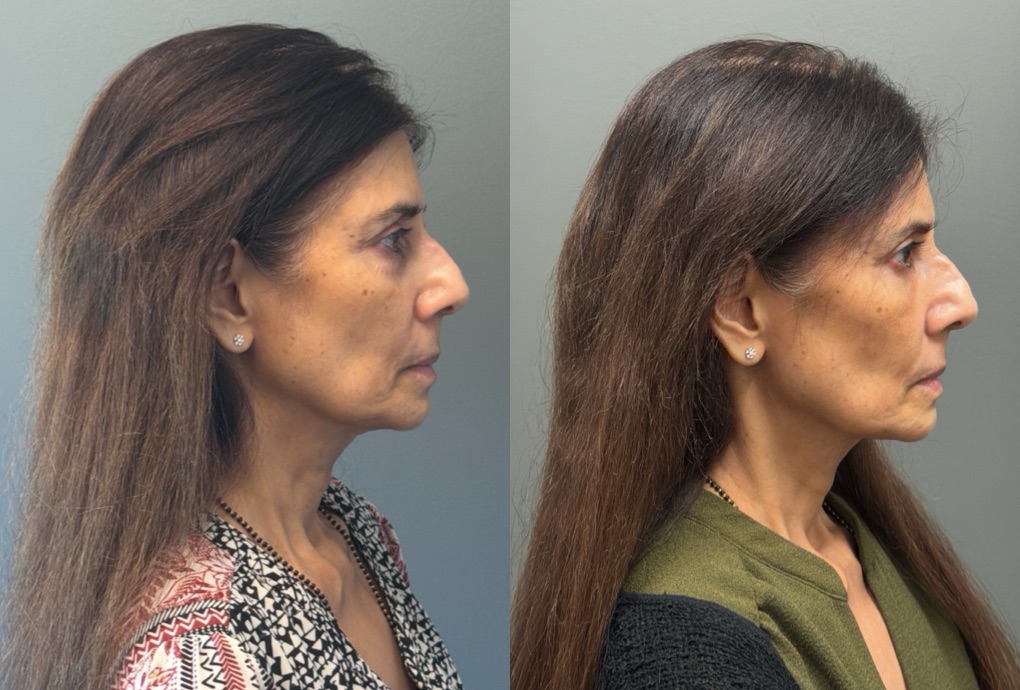 FAT GRAFTING Before & After Gallery - Patient 614030 - Image 3