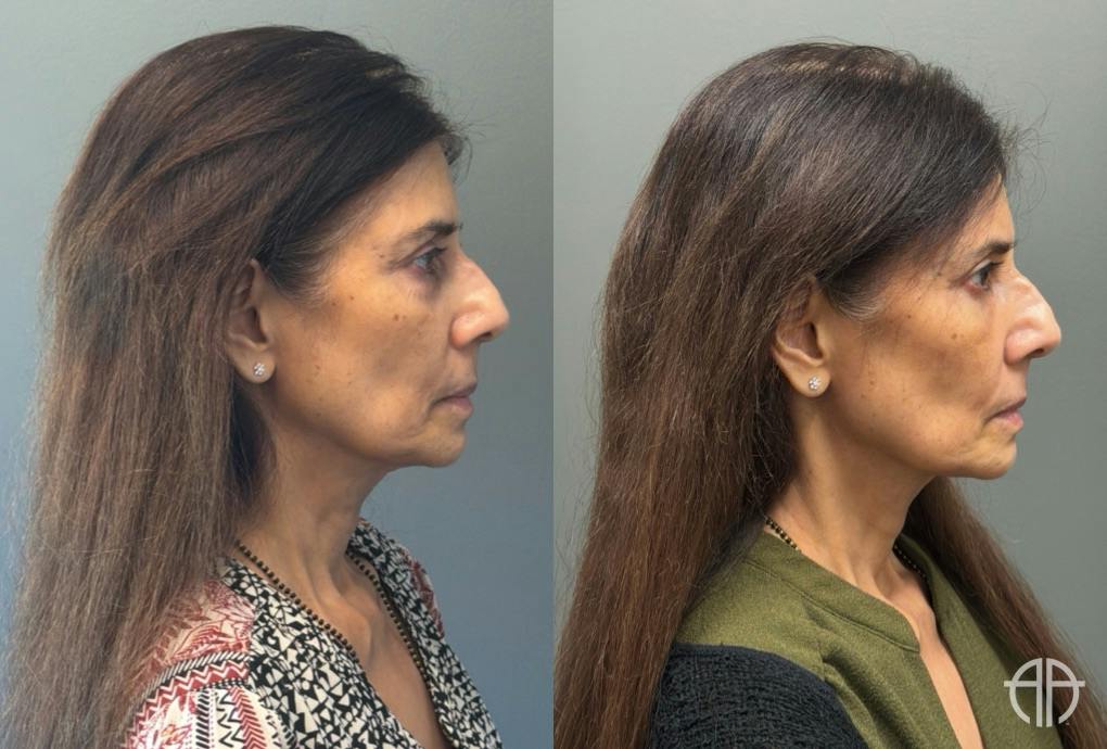 FAT GRAFTING Before & After Gallery - Patient 614030 - Image 3