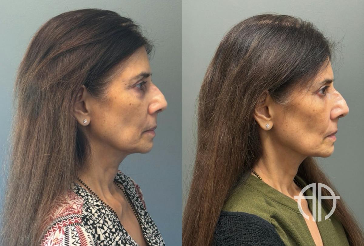 FAT GRAFTING Before & After Gallery - Patient 614030 - Image 3