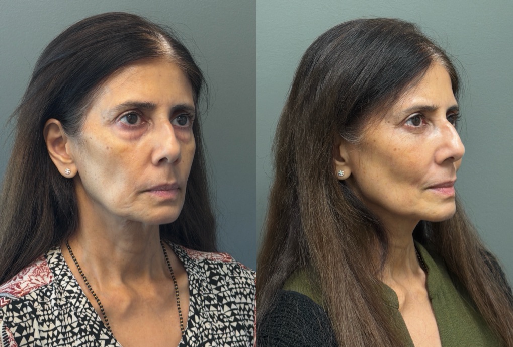 FAT GRAFTING Before & After Gallery - Patient 614030 - Image 5
