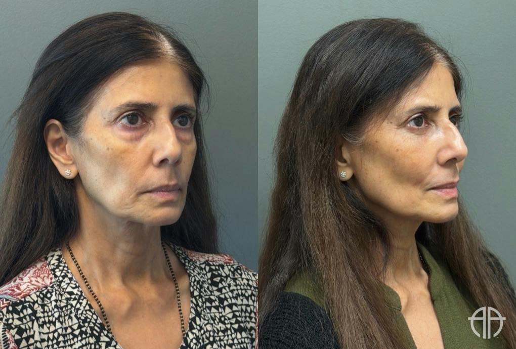 FAT GRAFTING Before & After Gallery - Patient 614030 - Image 5