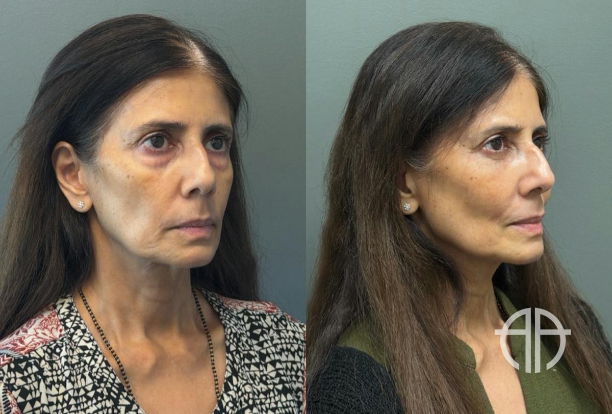 FAT GRAFTING Before & After Gallery - Patient 614030 - Image 5