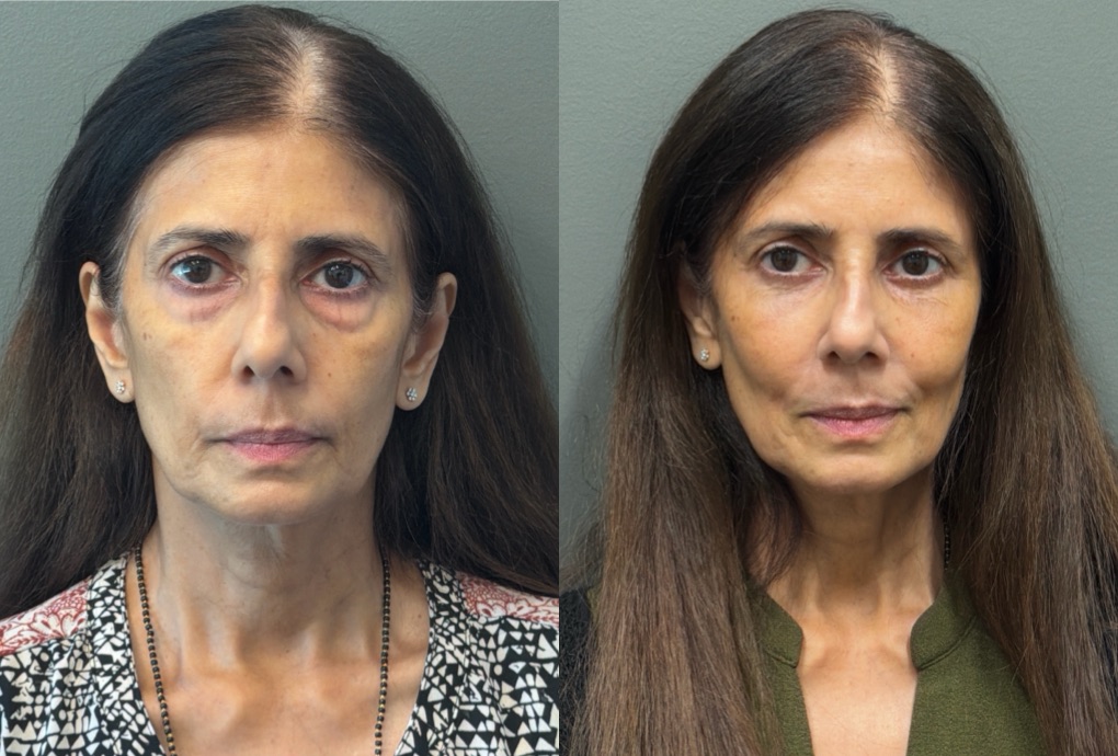 FAT GRAFTING Before & After Gallery - Patient 614030 - Image 1