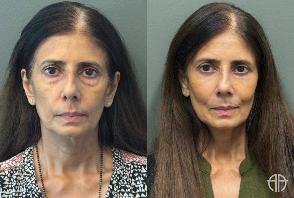 FAT GRAFTING Before & After Gallery - Patient 614030 - Image 1