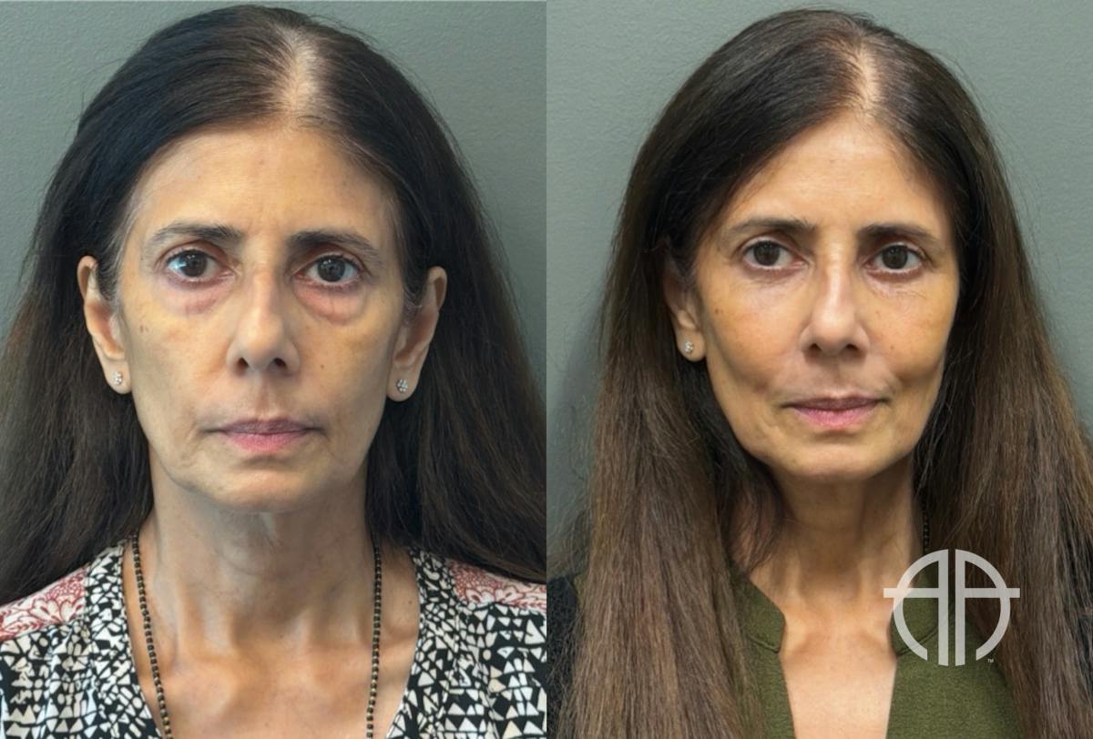 FAT GRAFTING Before & After Gallery - Patient 614030 - Image 1