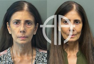 FAT GRAFTING Before & After Gallery - Patient 614030 - Image 1