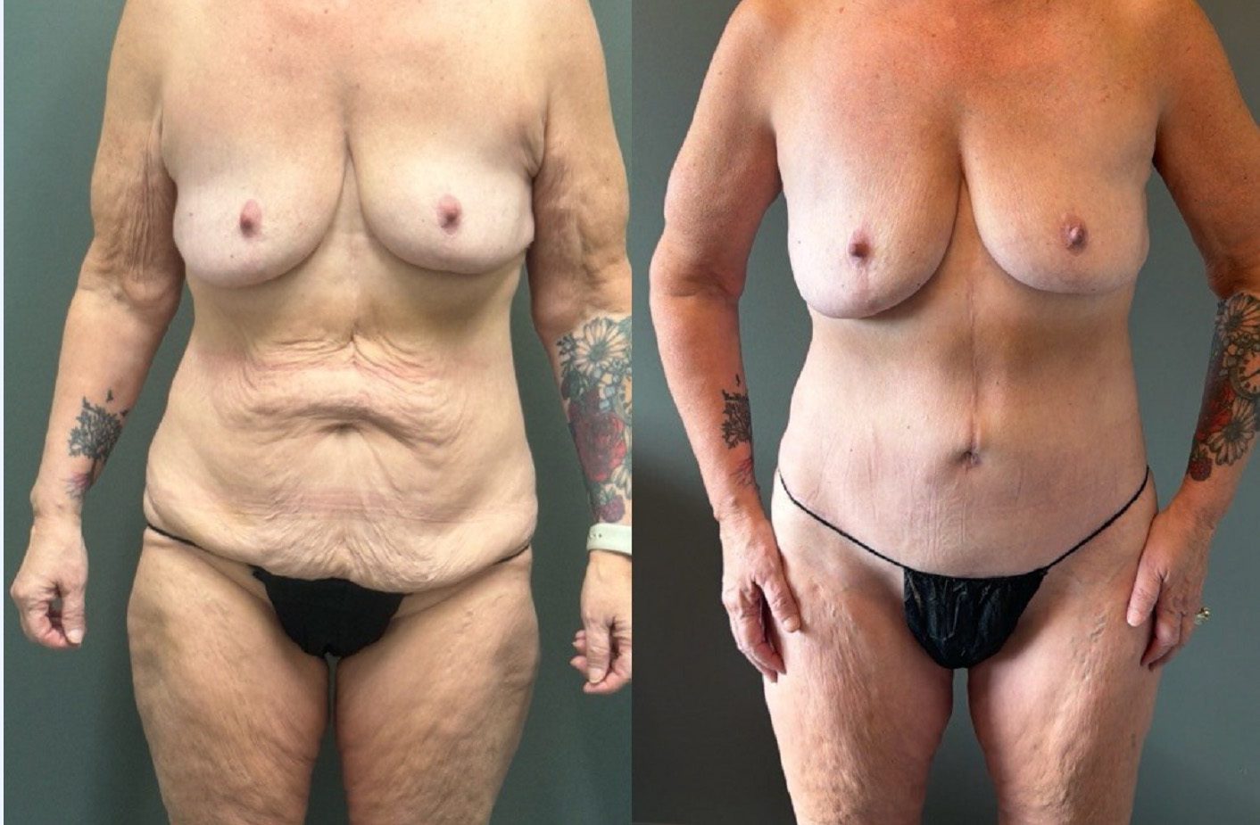 TUMMY TUCK Before & After Gallery - Patient 293566 - Image 1