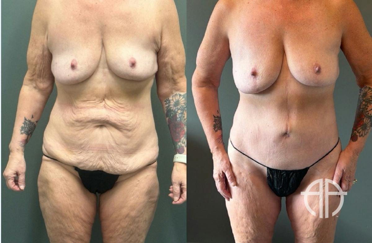 LIPOSUCTION Before & After Gallery - Patient 281568 - Image 1