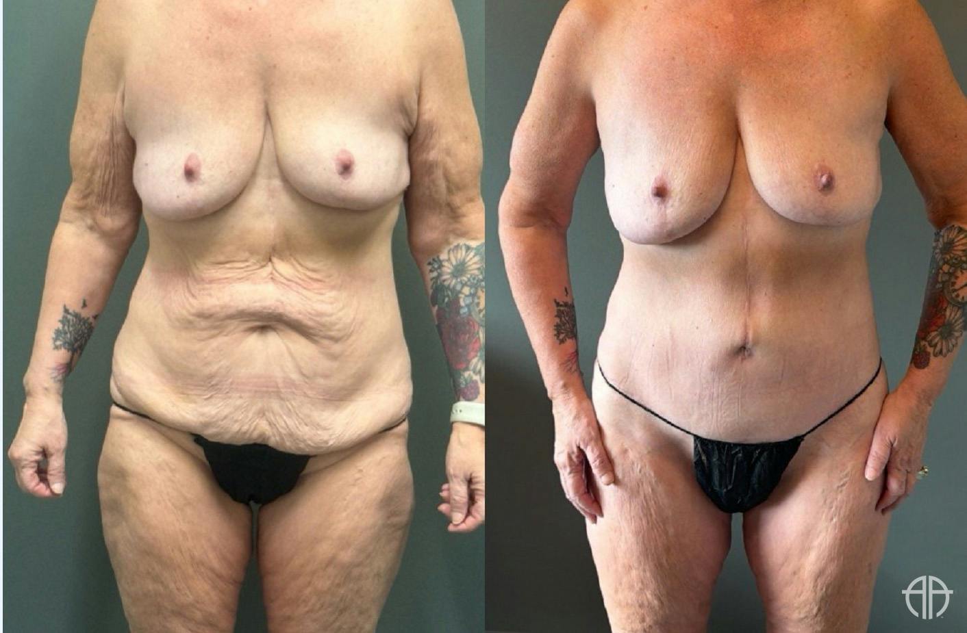 LIPOSUCTION Before & After Gallery - Patient 281568 - Image 1